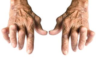 rheumatoid arthritis